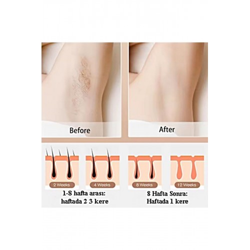 Buz Lazer Epilasyon 999.999 Atım- Cilt Gençleştirici- Giderici- Lazer Epilasyon Aleti no:2